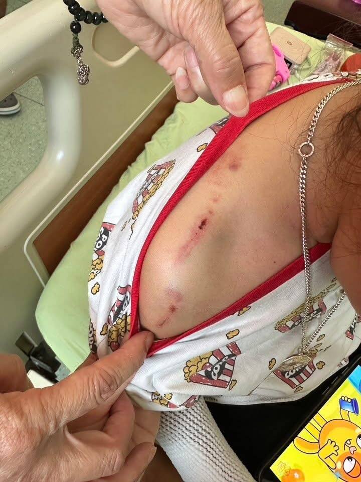 女童手臂等多处被咬伤。（翻摄脸书我是三义人）