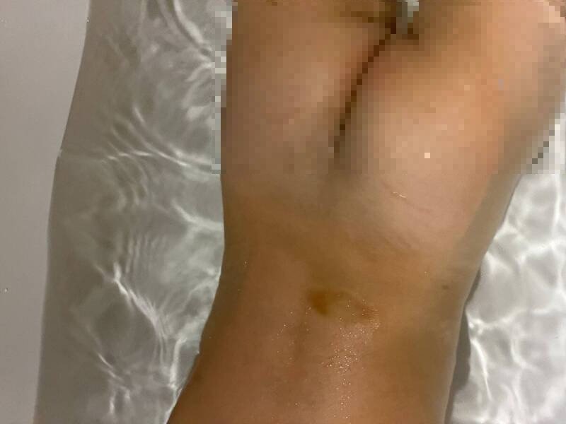 新竹市再传私立幼儿园老师对幼童施暴， 数名幼童遭闪耳光捏大腿转耳朵，身体也出现多处淤青。（读者提供）