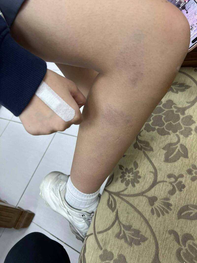 新北市永和区1间私立高职受害高一女学生遭高三男学生霸凌，身上多处擦挫伤。（翻摄「许明伟」脸书）